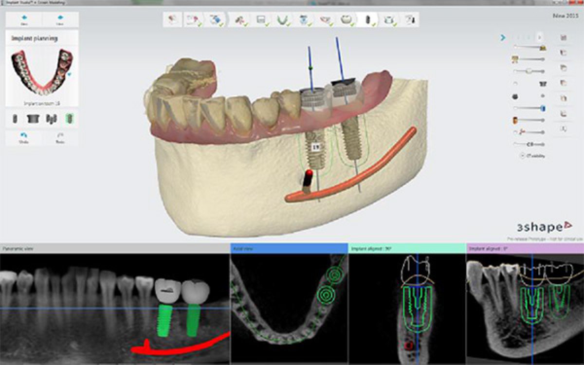 Implant Studio™ 2015 Software veröffentlicht 
