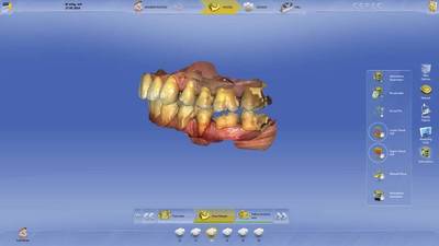 Sirona verbindet Innovation und Benutzerfreundlichkeit mit der neuen CEREC 4.3 Dental-Software